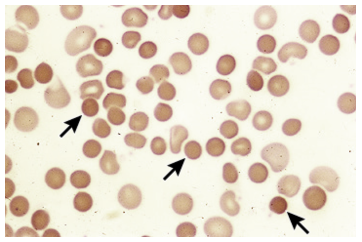 <p>Diagnostics for Hereditary Spherocytosis</p>