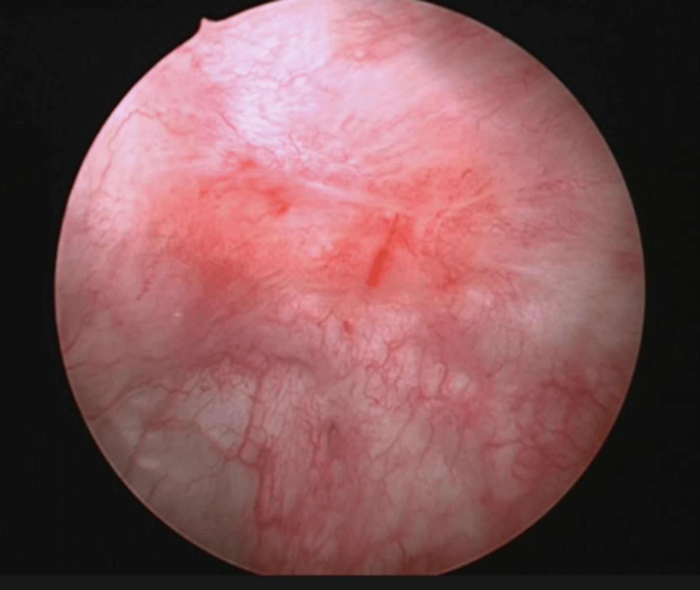 <p>Het cytologisch onderzoek is hoogsensitief voor ... (&gt; 90%). Dit is handig aangezien deze tuor moeilijk differentiëren is van cystitis via cystoscopie. Daarom worden cytologisch en cystoscopie altijd samen uitgevoerd.</p>