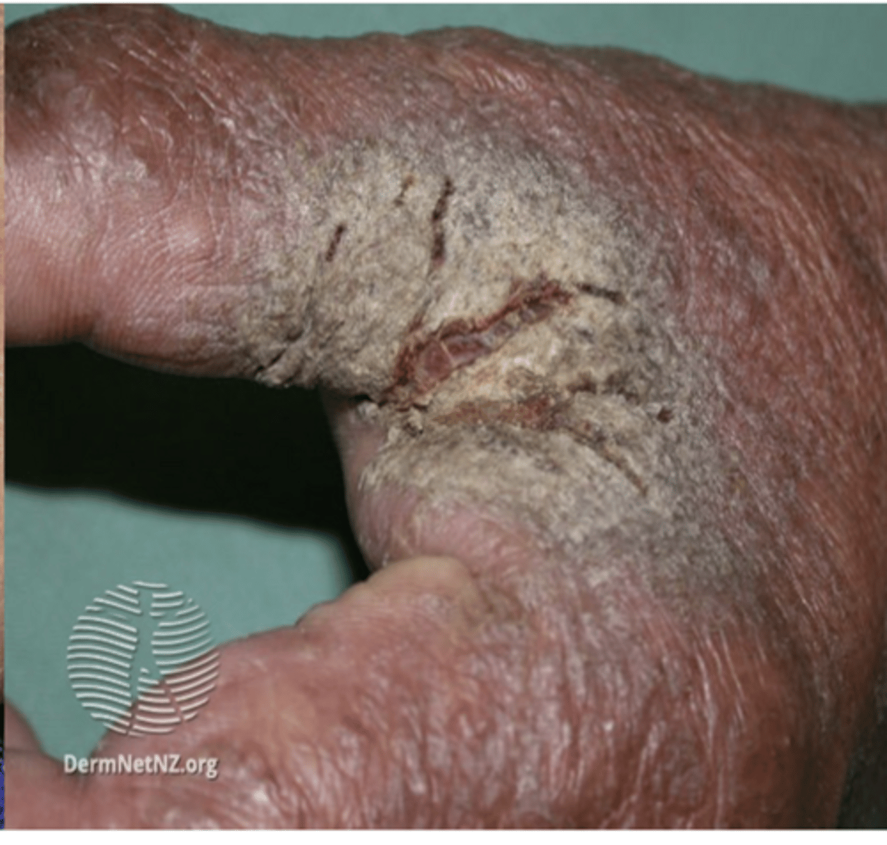 <p>- widespread pruritus</p><p>- linear burrows on the side of fingers, interdigital webs and flexor aspects of the wrist</p><p>- in infants, the face and scalp may also be affected</p><p>- secondary features are seen due to scratching: excoriation, infection</p>