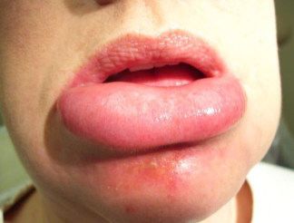 <p>triggered by allergic rection </p>