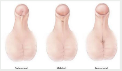 <p><strong>Hypospadias</strong></p><p>-Birth defect in which the ___________ of the ________ is not located at the ___ of the penis</p><p>-Typically on the ________ of the penis instead </p>