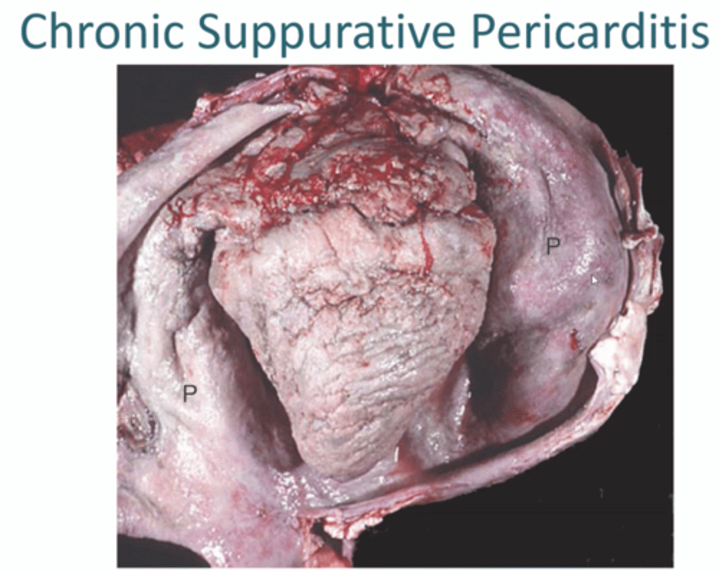 <p>1. Hardware disease in cattle, Pericardial surface thickened with white masses of fibrous tissue enclosing thick purulent exudate. Animals survive for weeks-months but die from CHF/septicaemia</p><p>2. Chronic, Often follows suppurative pericarditis, Extensive fibrous proliferation, fibrous adhesions between visceral and parietal surfaces</p>