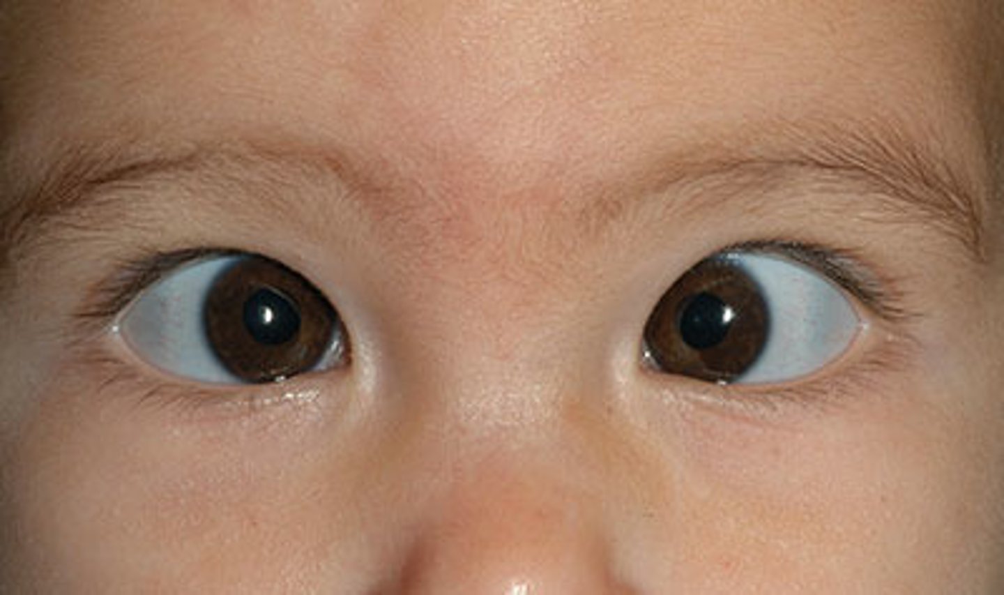 <p>sometimes called "crossed eyes". It is a condition where the eyes don't align properly and can be constant or intermittent</p>