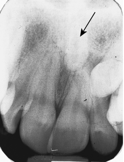 <p>43. What is the term for the extra tooth in Fig. 5.29 pointed out by the arrow?</p><p>a. Mesiodens</p><p>b. Macrodontia</p><p>c. Microdontia</p><p>d. Anodontia</p>
