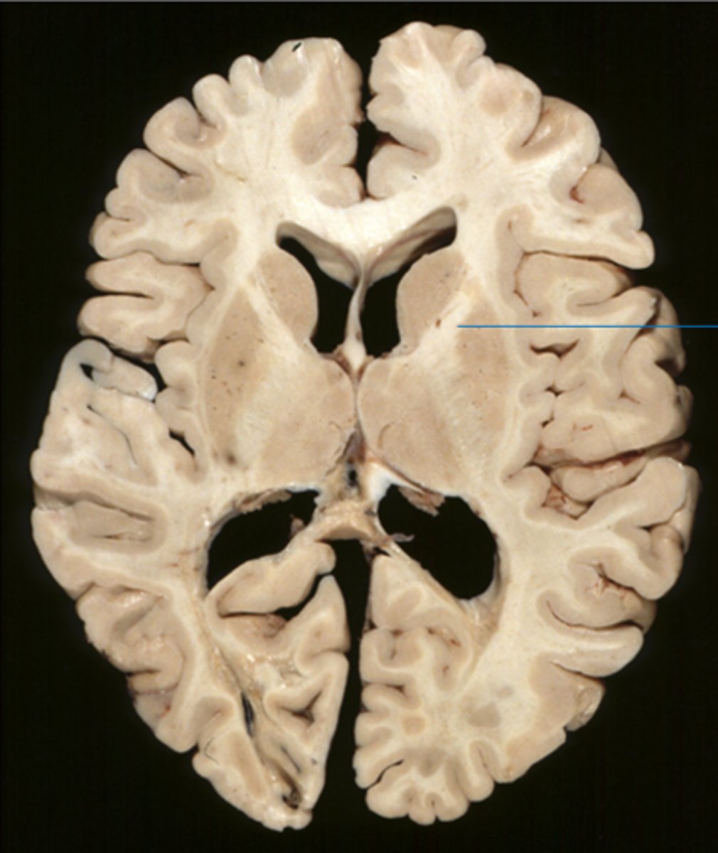 <p>Separates the <strong>head of the caudate nucleus</strong> from rostral aspect of the <strong>lentiform nucleus (putamen and globus pallidus)</strong></p>