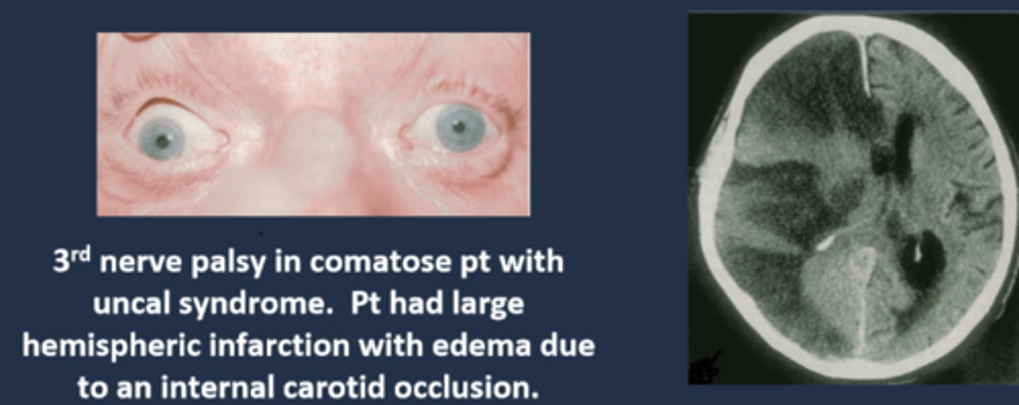 <p>1. miotic pupil due to initial cerbreal edema</p><p>2. ipsilateral dilated pupil due to expanding mass on that side</p><p>3. bilateral fixed and dilated pupils eventually</p>