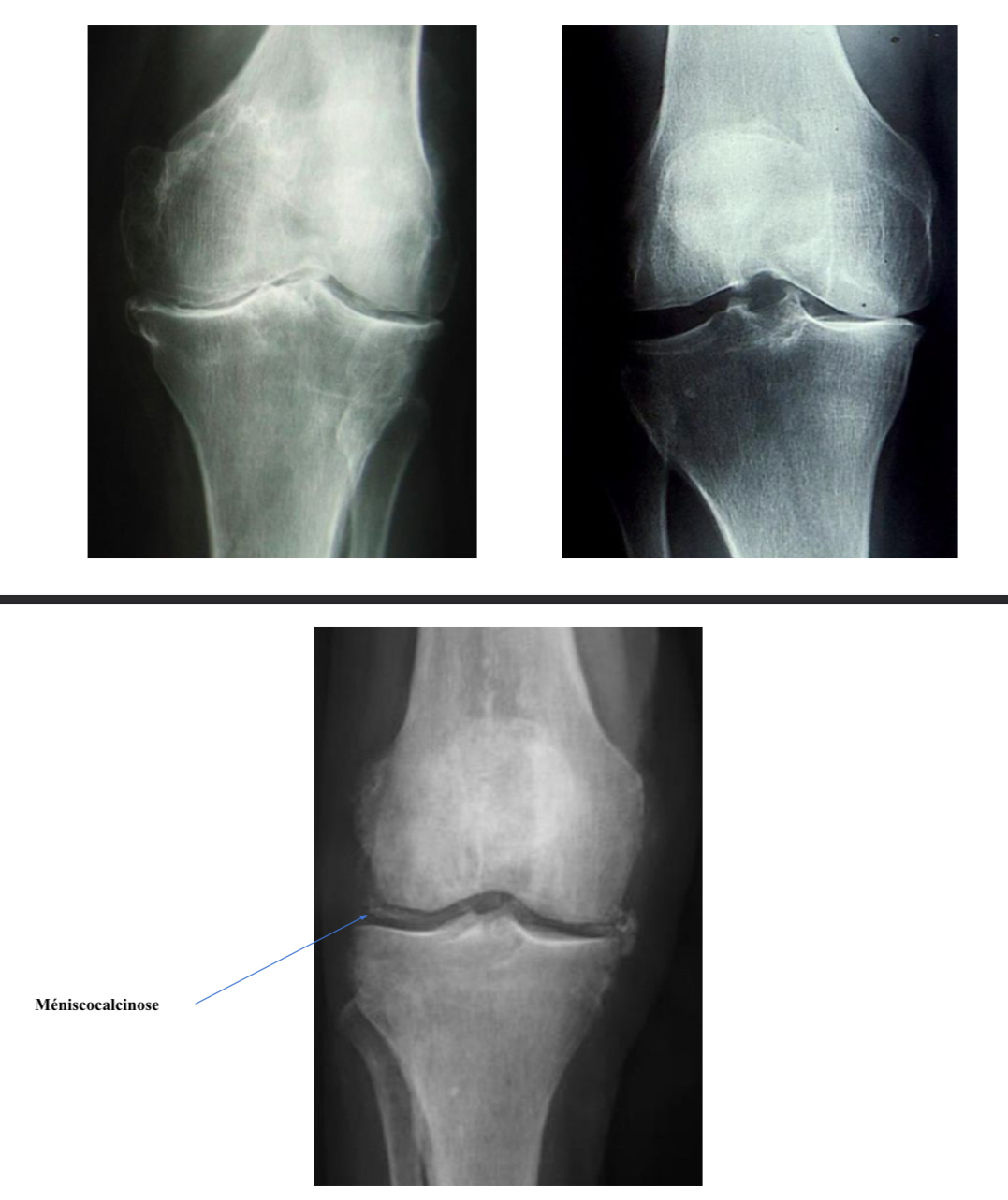 <p>= diminution de l’épaisseur de l’interligne</p><p>→ focal: pathologie mécanique (arthrose)</p><p>→ global : destruction globale du cartilage articulaire, en relation avec une pathologie nflammatoire (arthrite septique, rhumatisme inflammatoire ou micro-cristallin)</p><p></p>