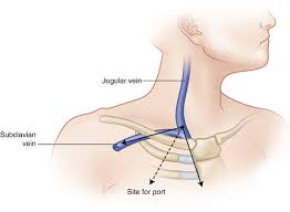 <p>b. It has entered the jugular vein and must be repositioned</p><p><sub><sup>A </sup></sub><strong><u><sub><sup>0.018-in. guidewire </sup></sub></u></strong><sub><sup>is inserted through the needle and advanced into the superior vena cava. A challenge with inserting the guidewire is to prevent it from traveling cephalad into the jugular vein. If this occurs, the guidewire will curve upward, looking like a “J,” meaning it has entered the jugular vein. The surgeon will carefully withdraw the guidewire from the jugular vein and reposition into the superior vena cava.</sup></sub></p><p></p>