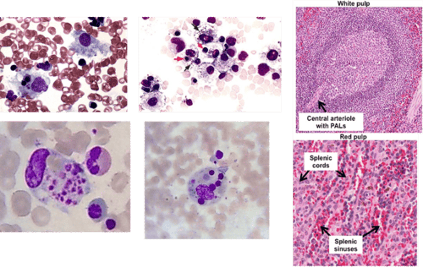 <p><span style="text-decoration:underline">Define Condition</span>:</p><p>-<span style="text-decoration:underline">Path</span>: Excessive release of IF-gamma from CD8+ T-cells –-&gt; macrophage activation --&gt; release of toxic levels of additional proinflammatory cytokines, such as TNF and IL-6 --&gt; phagocytosis of blood cells and their precursors</p><p>-<span style="text-decoration:underline">Hx</span>:</p><p>&gt; <span style="text-decoration:underline">Inherited</span> = D/t defects in genes (ex: PRF1 encoding perforin) that regulates immune cell function</p><p>&gt; <span style="text-decoration:underline">Acquired</span> = Infex, Malignancy (peripheral T cell lymphoma)</p><p>-<span style="text-decoration:underline">Sx/PE</span>:</p><p>&gt; Fever</p><p>&gt; Splenomegaly</p><p>-<span style="text-decoration:underline">Dx</span>:</p><p>&gt; PANCYTOPENIA</p><p>&gt; <span style="text-decoration:underline">Peripheral</span> = RBCs, Platelets or WBCs WITHIN CYTOPLASM OF MACROPHAGES</p><p>&gt; <span style="text-decoration:underline">BM</span> = Phagocytic Histiocytes w/ ingested platelets and red cell precursos</p>