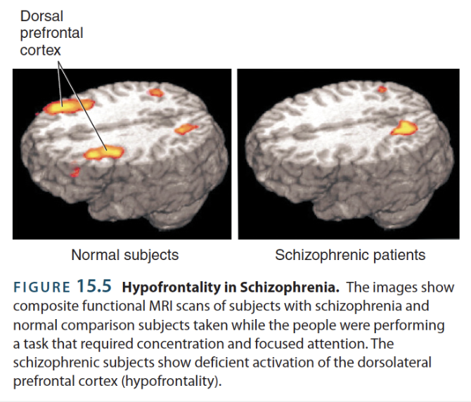 <p>→ decreased activity of the frontal lobes, particularly the dorsolateral prefrontal cortex, which may relate to the hypoactivity (↓) of local dopamine D1 receptors</p><ul><li><p>Consequence of negative symptoms of schizophrenia</p><p></p></li><li><p><u>Summarized finding</u>: Schizophrenia may be associated with too little dopamine in the prefrontal cortex and too much elsewhere</p></li></ul><p></p>
