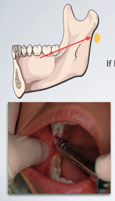 <p>Needle tip located too posteriorly</p>
