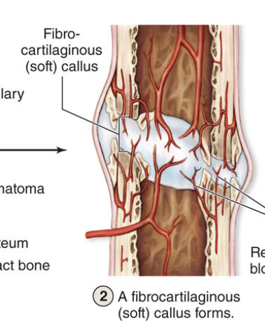 <ul><li><p><strong><u>Second step to fracture repair (take at least 3 weeks)</u></strong></p></li><li><p><strong><u>Soft callus of collagen &amp; cartilage &nbsp;bridge the broken bone</u></strong></p></li></ul><p></p>