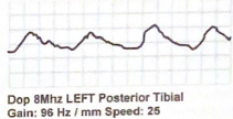 <p>What characteristics make the following waveform “monophasic”? use terms to describe upstroke, amplitude and flow reversal</p>