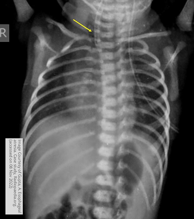 <p>What may be seen on a plain chest X-ray for acquired tracheoesophageal fistula?</p>
