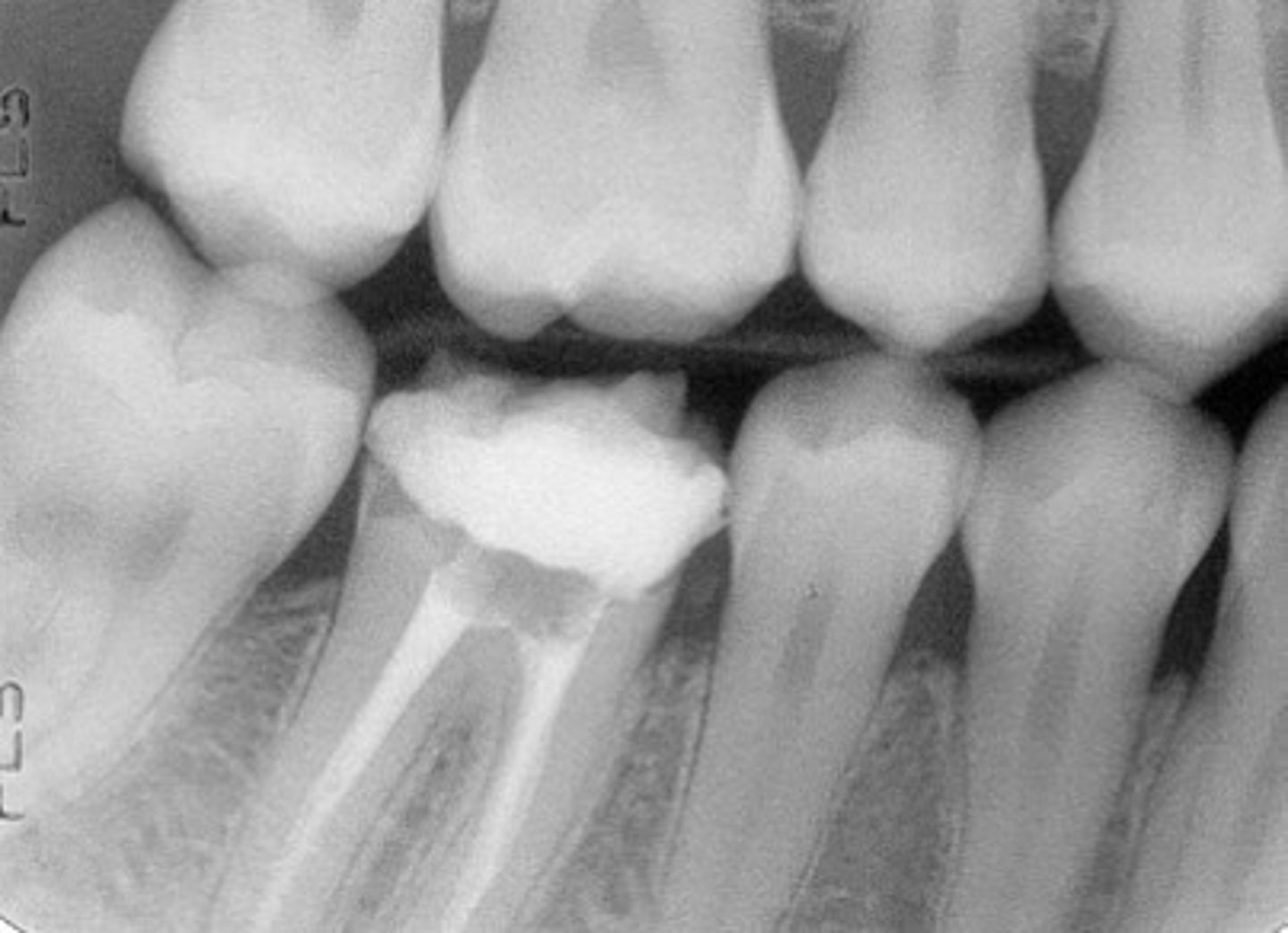 <p>image view showing the crowns of both arches on one film</p>