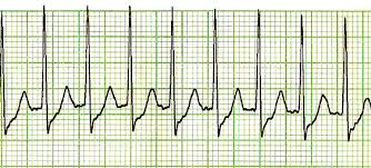 <p>Normal QRS</p>
