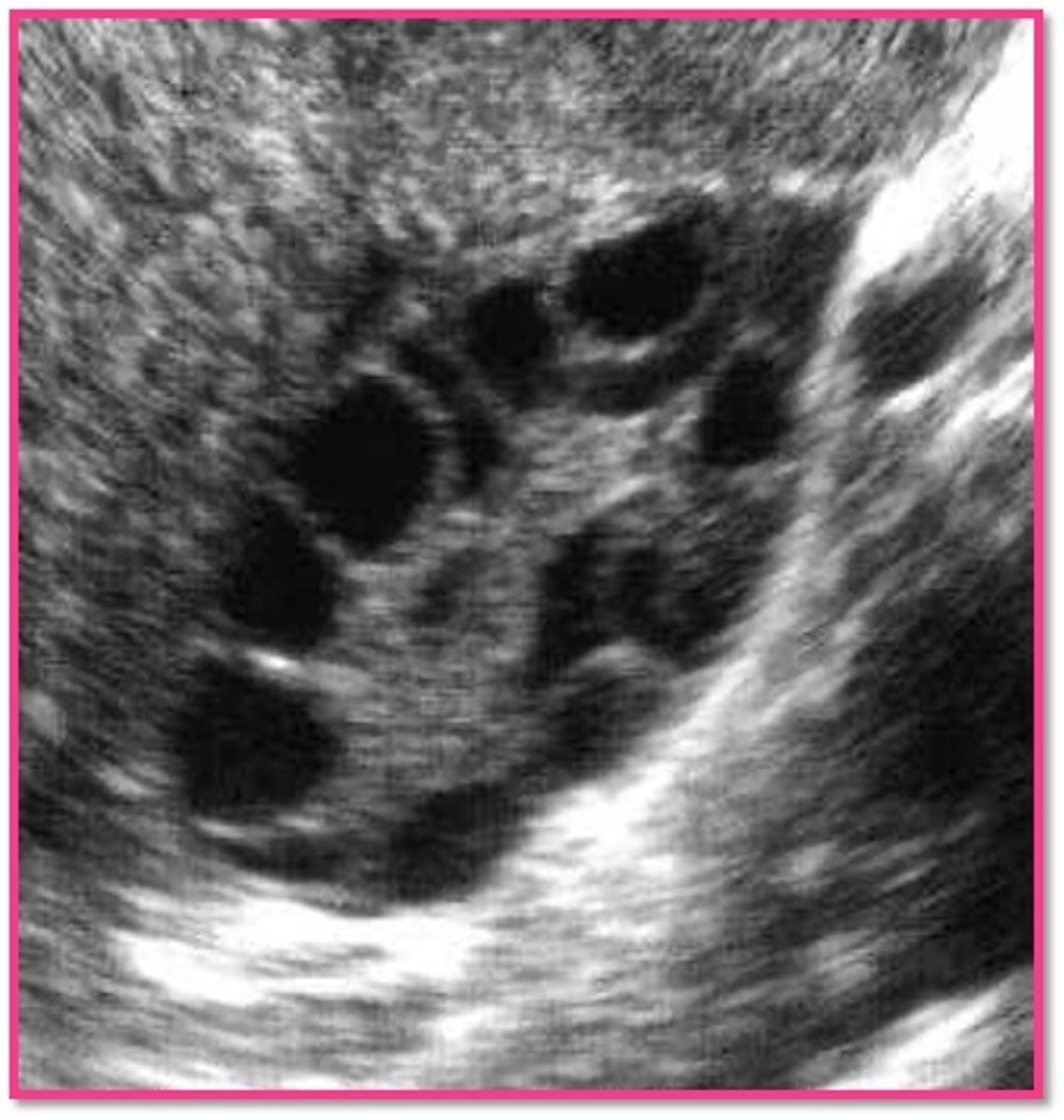 <p>follicles; anovulation</p>
