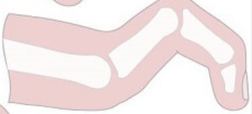 <p>PIP and DIP flexion, MTP hyperextension </p>