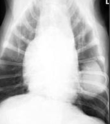 <p>-heartworm disease</p><p>-heart disease</p><p>-pneumonia</p><p>-pregnancy</p><p>-granulomatous disease</p>