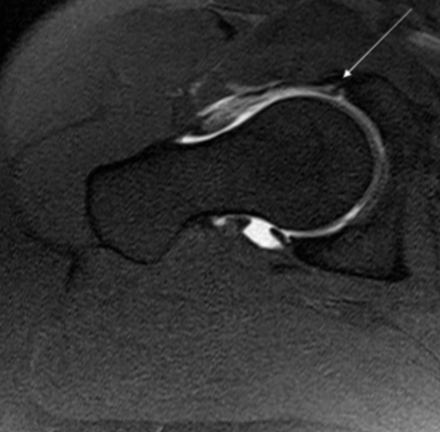 <p>Describe the pathology indicated by the arrow (Ax T1 FS). </p>