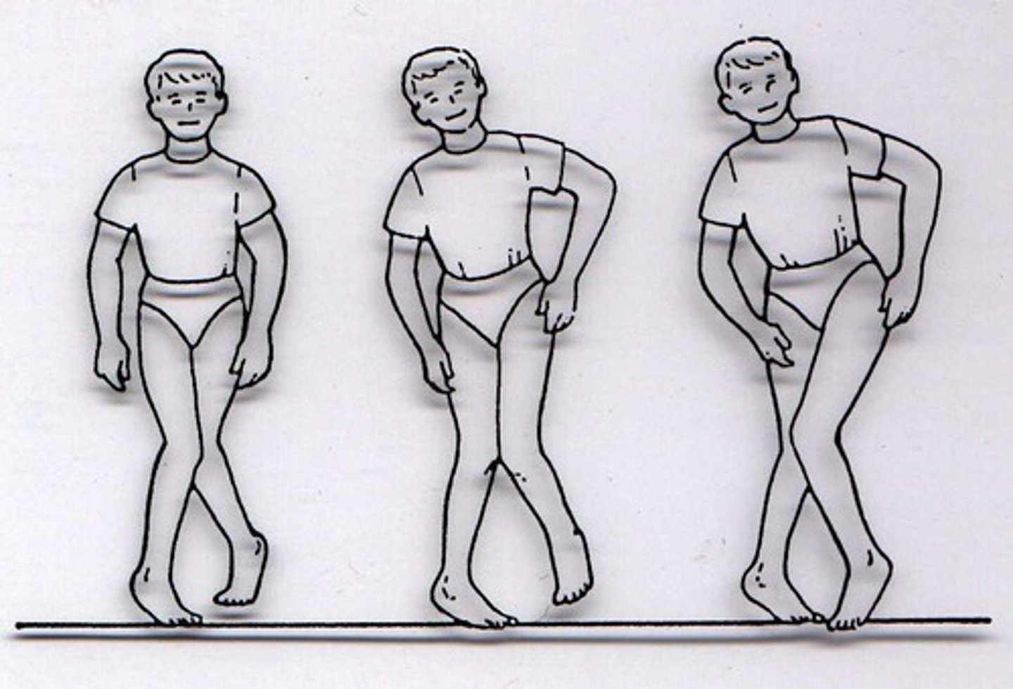 <p>the legs cross or meet in a scissors-like motion</p><p>- in kids alot of the time</p>