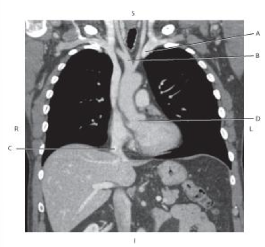 <p>Which line points to the <span style="color: purple">inferior vena cava?</span></p>