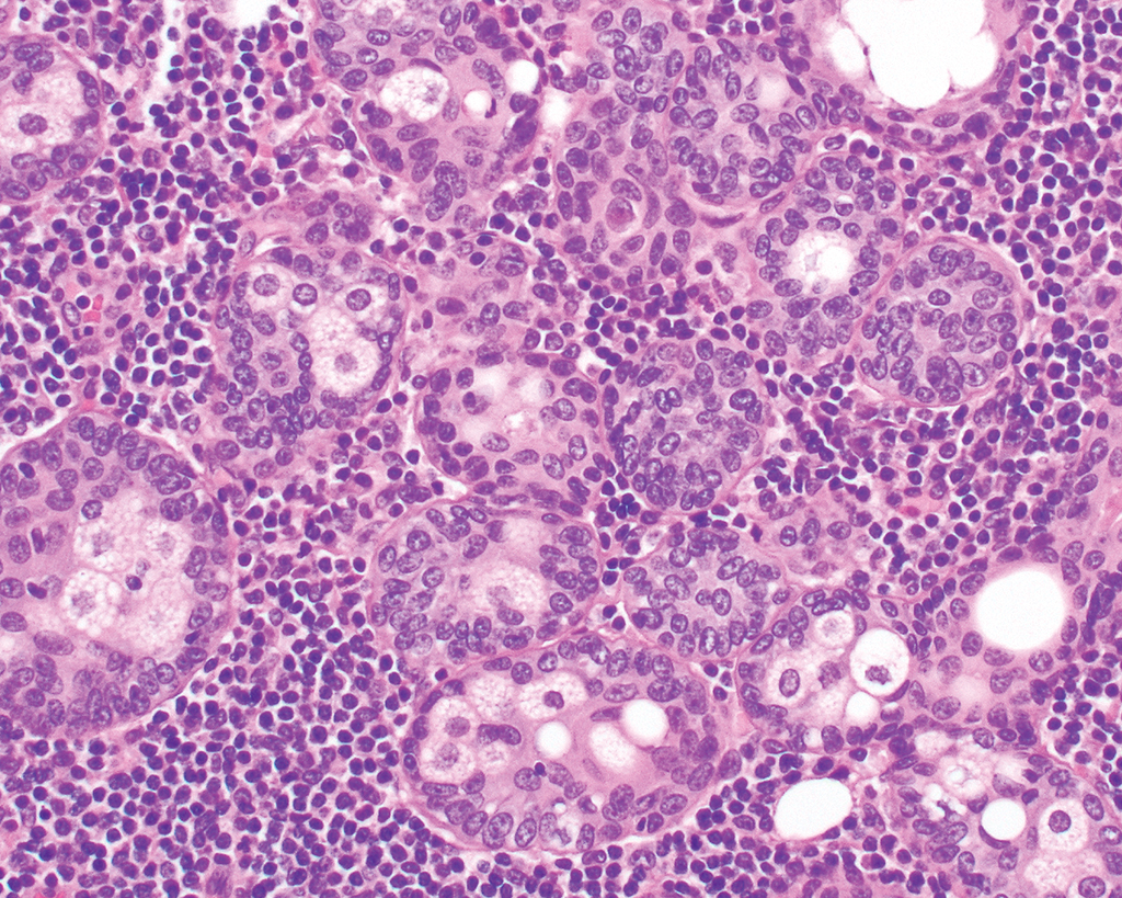 <p>Patient de 70 ans avec masse parotide </p><p>1) diagnostic </p><p>2) Localisation</p><p>3) Histologie </p><p>4) IHC </p>