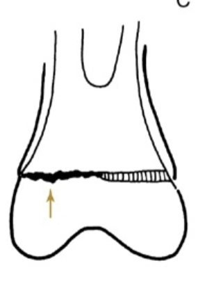 <p><strong>What type of Salter Harris fracture is the following:</strong></p><p>Crush or impaction of the Physis plate</p>