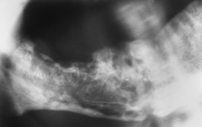 <p>malignancy </p><p>moth eaten destructive RL </p>