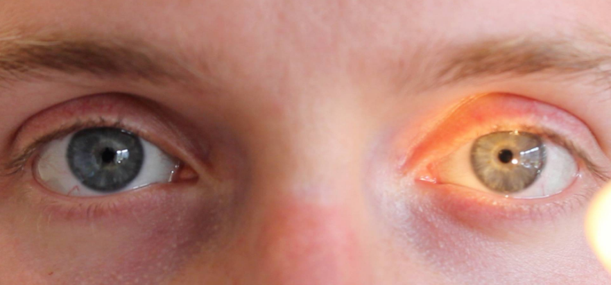 <p>Which eye is exhibiting a consensual light reflex? Why?</p>