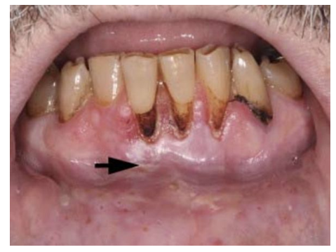 <p>-painless loss of gingival tissue in area of tobacco contact (very common)</p><p>-destruction of the facial alveolar bone</p><p>-correlates with quantity of daily use and duration of use</p>