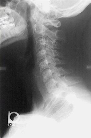 <p>What is this x-ray demonstrating?</p>