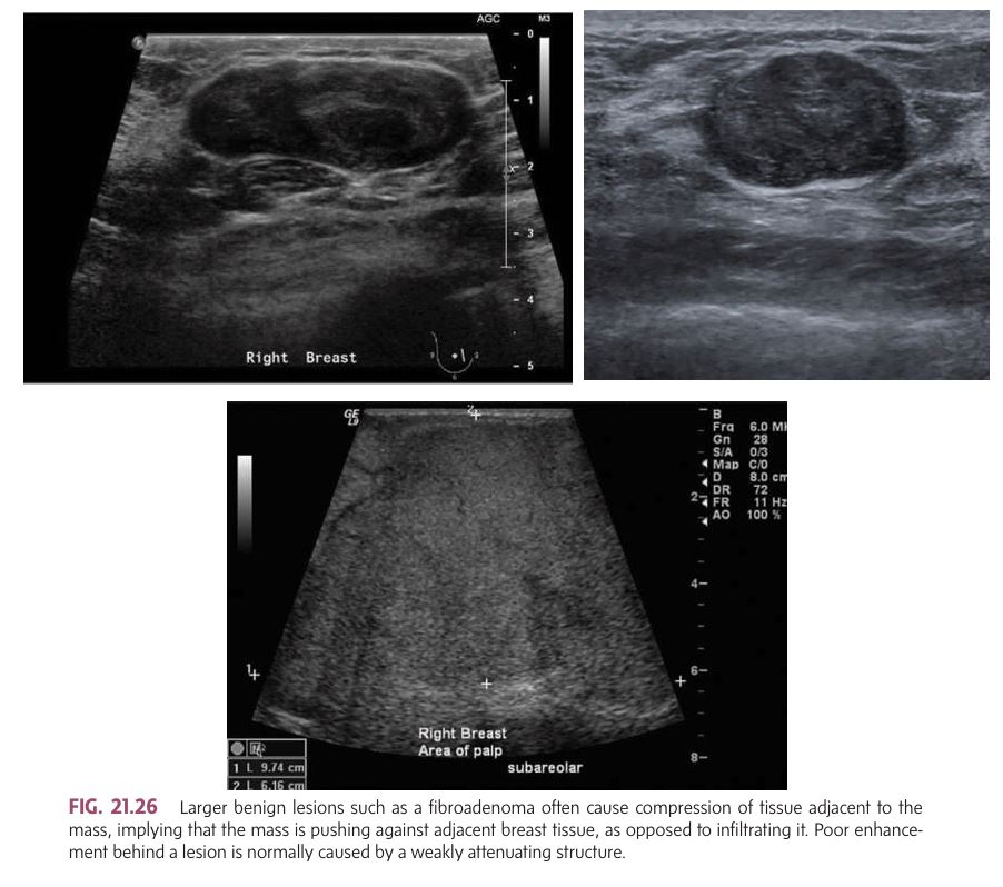<p></p><ul><li><p class=""><strong><mark data-color="yellow" style="background-color: yellow; color: inherit">Most common benign breast tumor in women aged 15-40.</mark></strong></p></li><li><p class=""><strong>Characteristics</strong>:</p><ul><li><p class="">Firm, rubbery, mobile, clearly separate from surrounding tissue.</p></li><li><p class="">Round/oval, smooth or lobulated.</p></li><li><p class="">Doesn't usually cause pain (mastodynia) and doesn't change size with the menstrual cycle.</p></li><li><p class="">Grows slowly but may rapidly increase in size with hemorrhage (bleeding inside the tumor).</p></li><li><p class="">If tumor grows more than 20% in 6 months, further investigation is needed (may suggest phyllodes tumor).</p></li></ul></li><li><p class=""><strong>Sonographic Features</strong>:</p><ul><li><p class=""><strong>Smooth, rounded margins</strong> and <strong>low-level homogeneous internal echoes</strong>.</p></li><li><p class=""><strong>Intermediate posterior enhancement</strong> (clearer behind the mass).</p></li><li><p class="">May appear <strong>hypoechoic</strong> (darker) compared to breast fat but can sometimes be <strong>hyperechoic</strong> (brighter).</p></li><li><p class="">Larger fibroadenomas may compress surrounding tissue.</p></li></ul></li></ul><p></p>