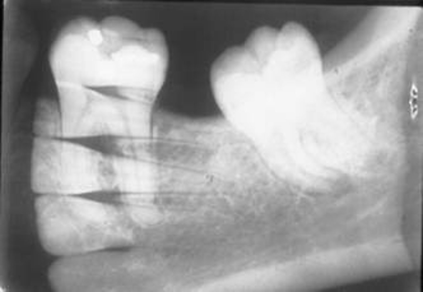 <p>image appears dark with superimposed structures</p><p>always separate exposed and unexposed receptors</p>