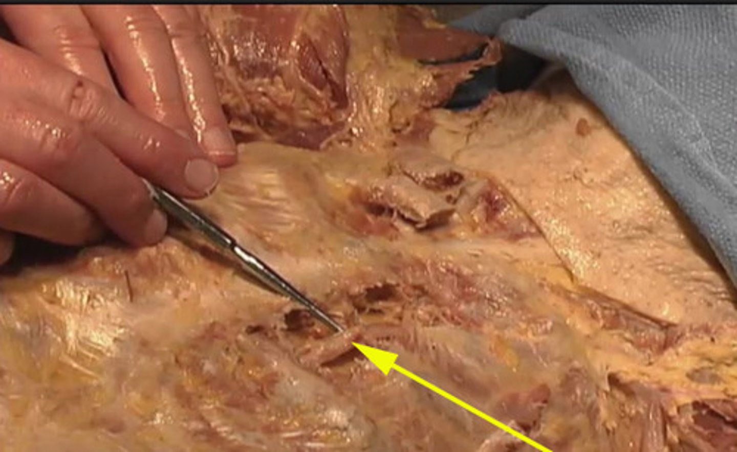 <p>What is this structure is being shown here?</p><p>epidermal artery</p><p>mylin sheath</p><p>internal thoracic vein</p><p>internal thoracic artery</p>