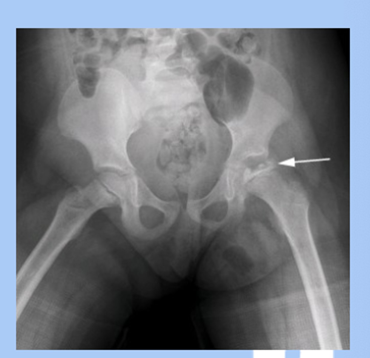 <p>-idiopathic osteronecrosis (avascular necrosis) of the hip </p><p>-RF: 3-12yo, males, bilateral in 15% </p><p>-sx: insidious onset, painless limp </p><p>-dx: high index of suspicion, initial XR normal, as progresses XR shows fragmentation of femoral head and then healing of femoral head </p><p>-tx: non weight bearing, immediate referral </p>