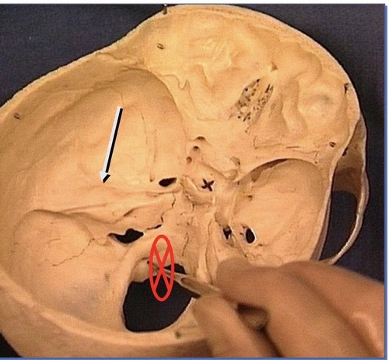 <p>1. On petrous portion of temporal bone</p><p>2. Semicircle canal under it, giving it a bump</p>
