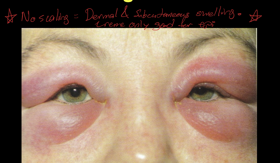<ul><li><p>Contact Dermatitis</p></li><li><p>Severe Allergic conjunctivitis/blepharitis</p></li><li><p>Poison Ivy</p></li><li><p>Bee stings</p></li></ul><p></p>