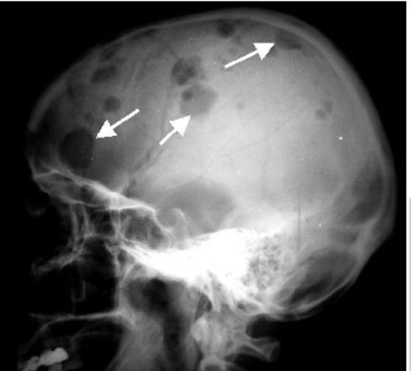 <p>Osteolytic lesions with calcifications </p><p>(spots of bone damage that result from cancerous plasma cells building up in your bone marrow.)</p>