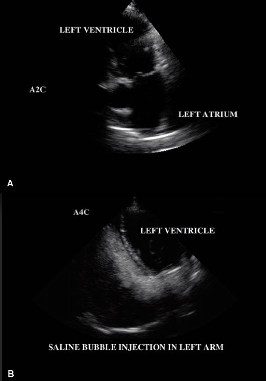 <p>A patient with exertion SOB had a saline contrast injection performed to assess for intracardiac shunting. A right arm saline injection detected no evidence of intracardiac shunting. However, an apical 4 chamber image before and after a left arm saline contrast injection.</p>