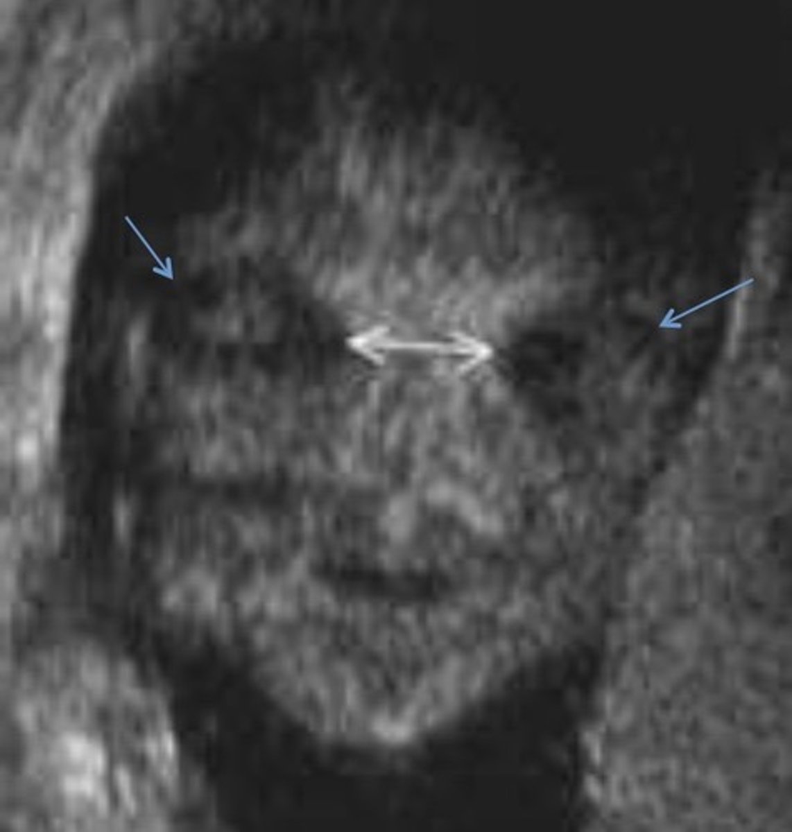 <p>Wide spread eyes</p><p>Common with frontal cephalocele</p>