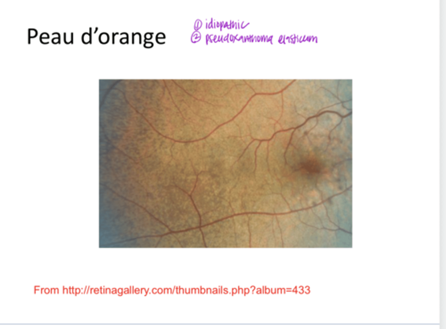 <p>Peau d'orange (Pic)</p>