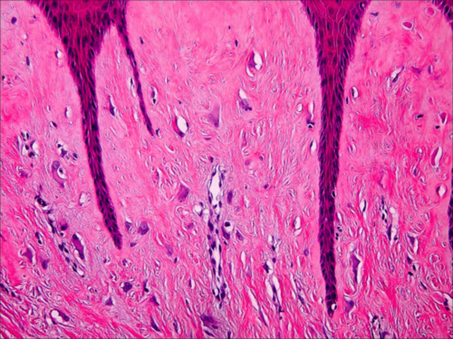 <p>vascular fibrous connective tissue , numerous large stellate fibroblasts that contain several nuclei and rete ridges narrow and elongated. This is associated with what pathology?</p>