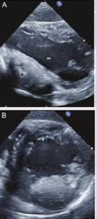 <p>Second most common benign cardiac tumor in children and infants.</p><p>Located in the myocardium - usually in the ventricle (at the septum.</p><p>Firm or rubbery and don’t demonstrate hemorrhage or necrosis. Very large, sometimes exceeding 10 cm in diameter.</p><p>Calcifications; usually solitary. Can regress with age.</p>
