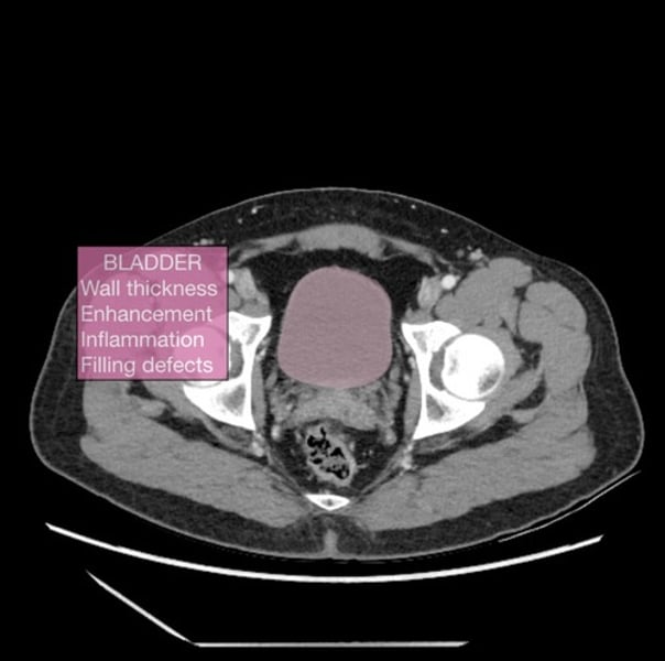 <p>hand-held ultrasound device, which can perform a quick, easy and non-invasive scan of the bladder<br>- calculates bladder volume</p>