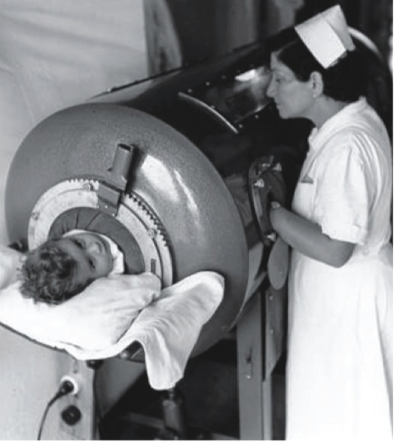 <ul><li><p>Most infections are asymptomatic </p></li><li><p>~0.5% of poliovirus infections result in muscle weakening (weaken muscles for breathing). </p><ul><li><p>“Iron lung”</p></li></ul></li><li><p>Most people recover </p></li><li><p>In come cases people die or are permanently paralyzed </p></li><li><p>Chlorine is in swimming pools to reduce infections! </p><ul><li><p>Poliovirus is a gastrointenstinal virus (transitted orally and fecally) </p></li></ul></li><li><p>There is also a vaccine </p></li></ul><p></p>