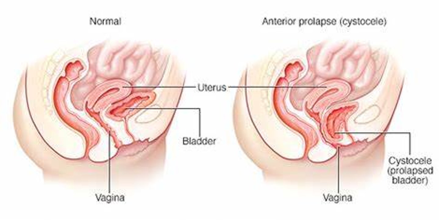 <p>bulging of the bladder into the vagina</p>