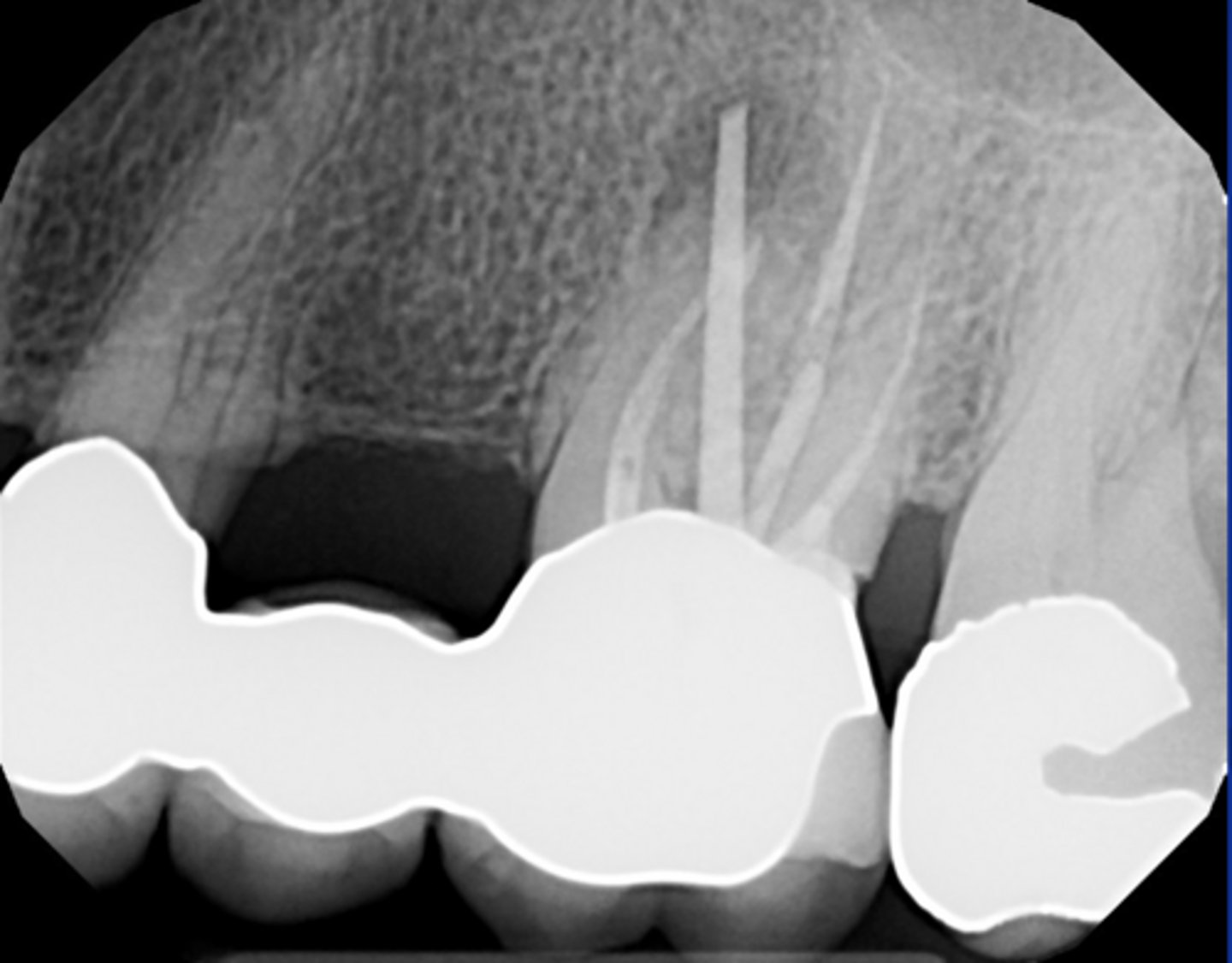<p>RCT 10 years ago thru bridge</p><p>Sinus tract 3 years ago...apicoectomy done</p><p>Sinus tract returned.</p><p>What do we do?</p>