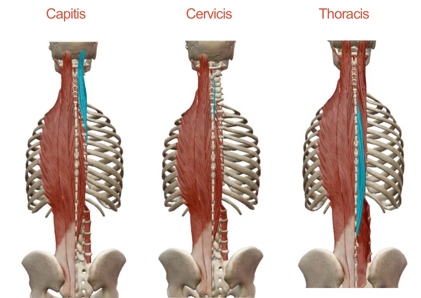 <p>Erector Spinae: Spinalis</p><p>Origin: </p><p><strong>Capitis</strong>: Arises with semispinalis capitis</p><p><strong>Cervicis</strong>: ligamentum nuchae and spinous process of C7</p><p><strong>Thoracis</strong>: Spinous processes of superior lumbar and inferior thoracic vertebrae </p><p>Insertion:</p><p><strong>Capitis</strong>: Occipital bone</p><p><strong>Cervicis</strong>: Spinous process of axis</p><p><strong>Thoracis</strong>: Spinous processes of superior thoracic vertebrae </p><p>Action: <strong>Together</strong>: Extend vertebral column at respective regions</p><p><strong>Innervation</strong>: Spinal nerves</p>