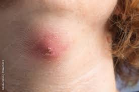 <p><span>A type of acute INFLAMMATION characterized by infiltration of neutrophils at the microscopic level and formation of pus at the gross level. ABSCESS is special type of suppurative inflammation.</span></p>